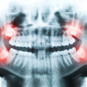 Teeth x-rays